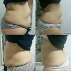 RF Weight Loss Cellulite Removal Machine Vela Shape  0-0.07MPa 1 year Warrenty